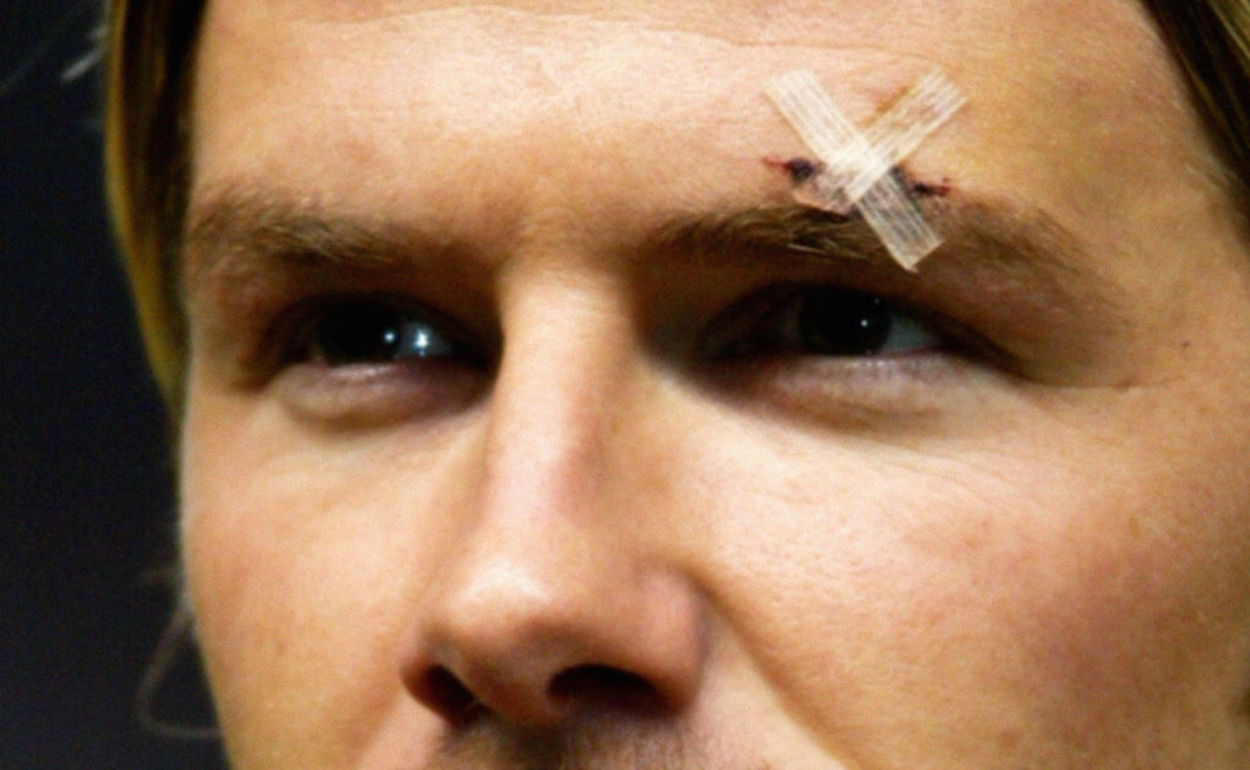 David Beckham wears a bandage over his eye in 2003.
